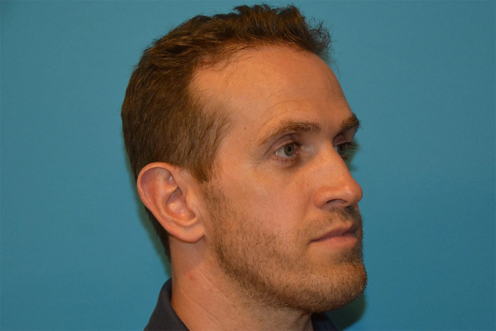 Facial Fat Transfer Real Patient Results by Dr. Scott Urban in Salt Lake City, Utah