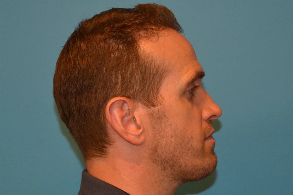 Facial Fat Transfer Real Patient Results by Dr. Scott Urban in Salt Lake City, Utah