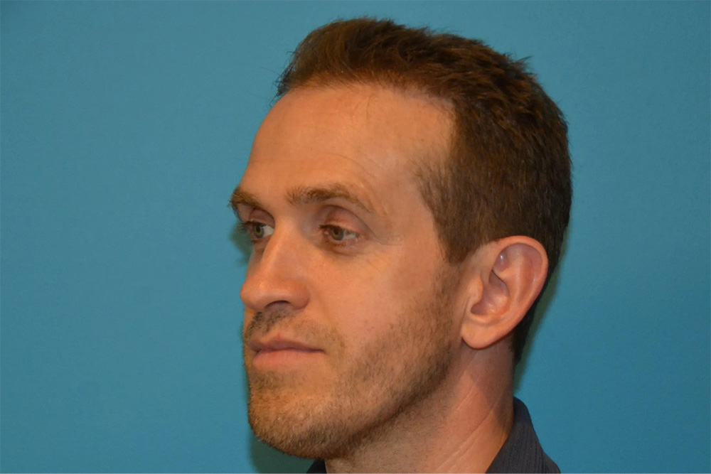 Facial Fat Transfer Real Patient Results by Dr. Scott Urban in Salt Lake City, Utah