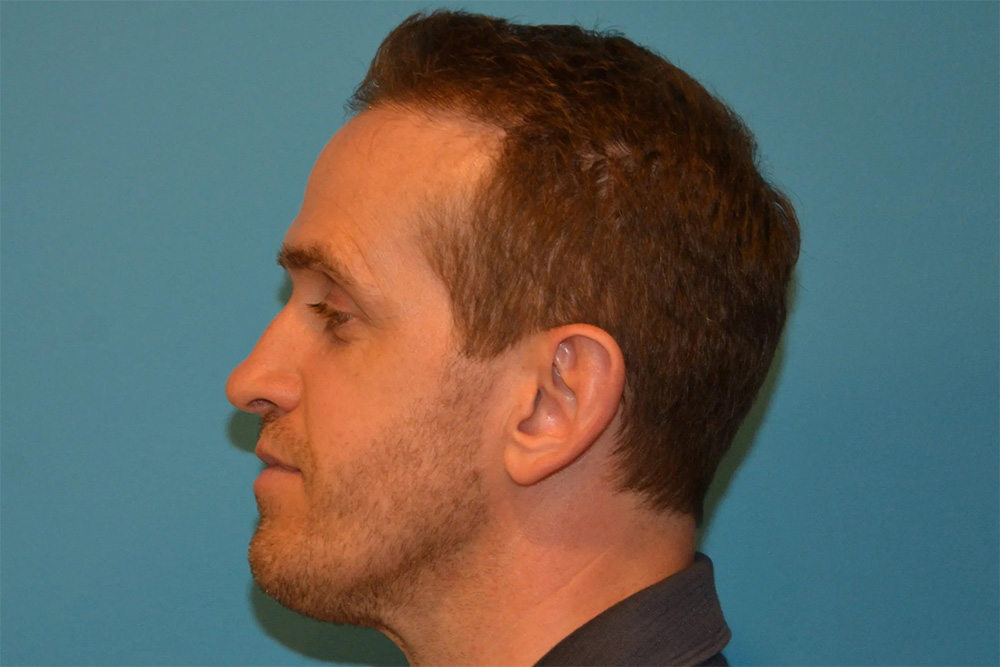 Facial Fat Transfer Real Patient Results by Dr. Scott Urban in Salt Lake City, Utah