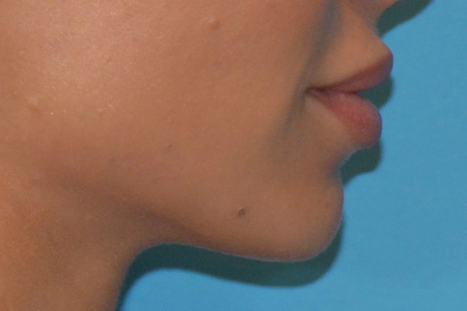 Chin Implants Real Patient Results by Dr. Scott Urban in Salt Lake City, Utah