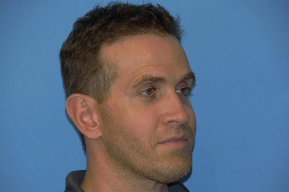 Facial Fat Transfer Real Patient Results by Dr. Scott Urban in Salt Lake City, Utah