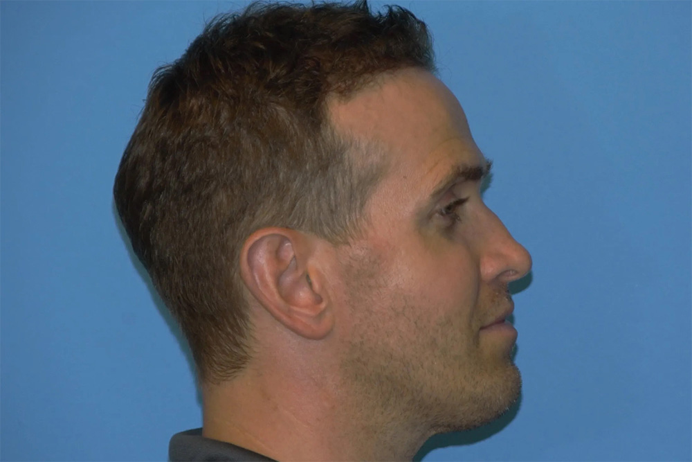 Facial Fat Transfer Real Patient Results by Dr. Scott Urban in Salt Lake City, Utah