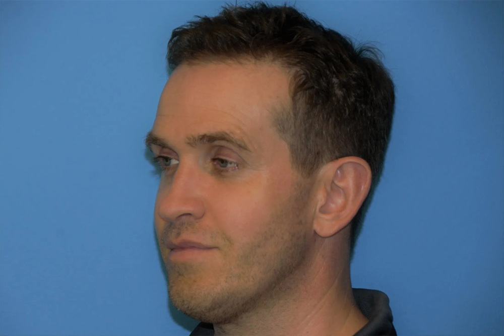 Facial Fat Transfer Real Patient Results by Dr. Scott Urban in Salt Lake City, Utah