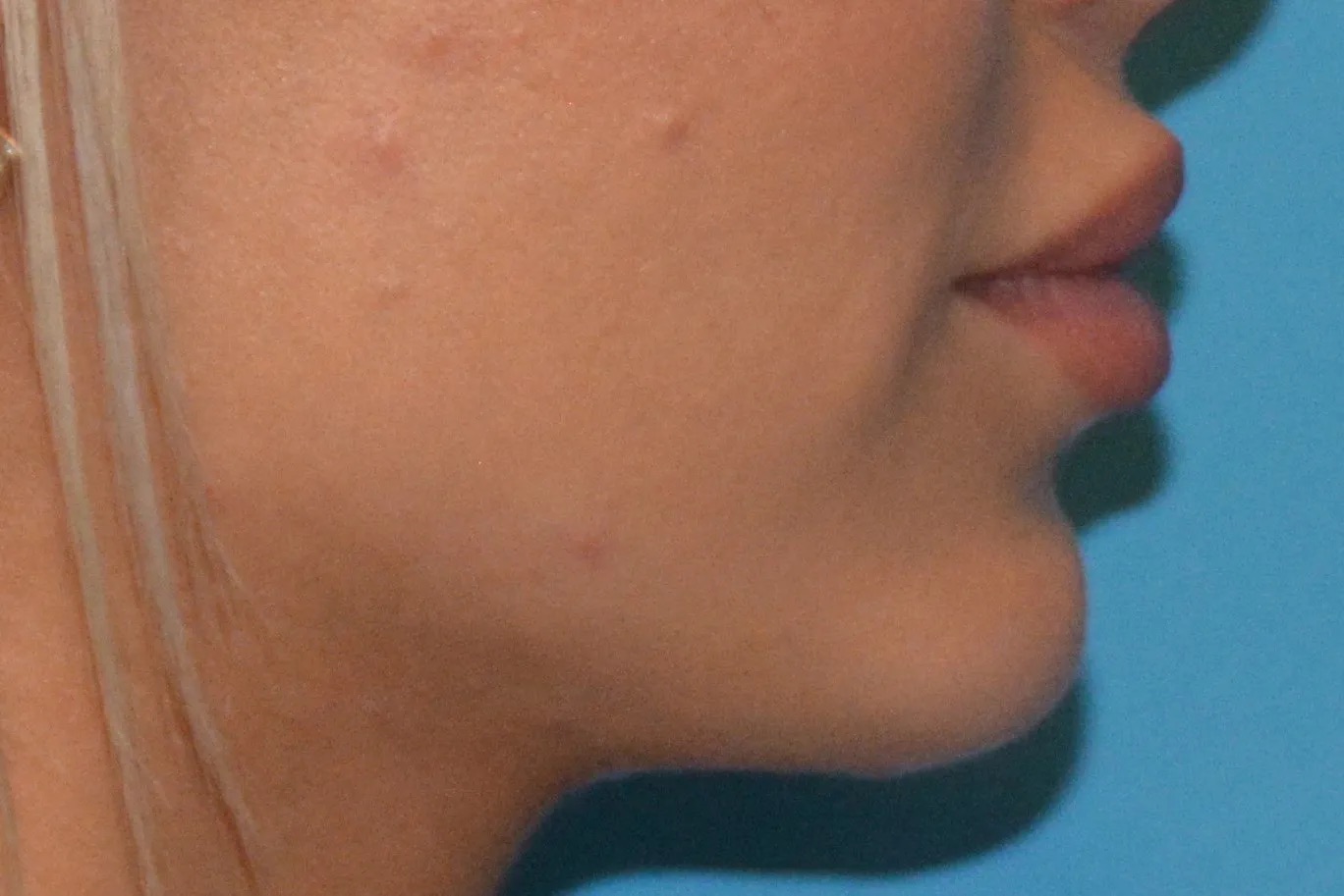 Chin Implants Real Patient Results by Dr. Scott Urban in Salt Lake City, Utah