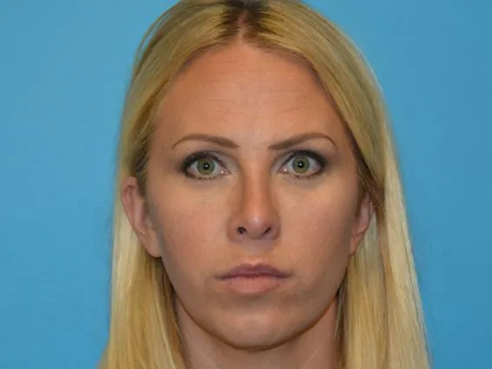 Cheek Implants Real Patient Results by Dr. Scott Urban in Salt Lake City, Utah