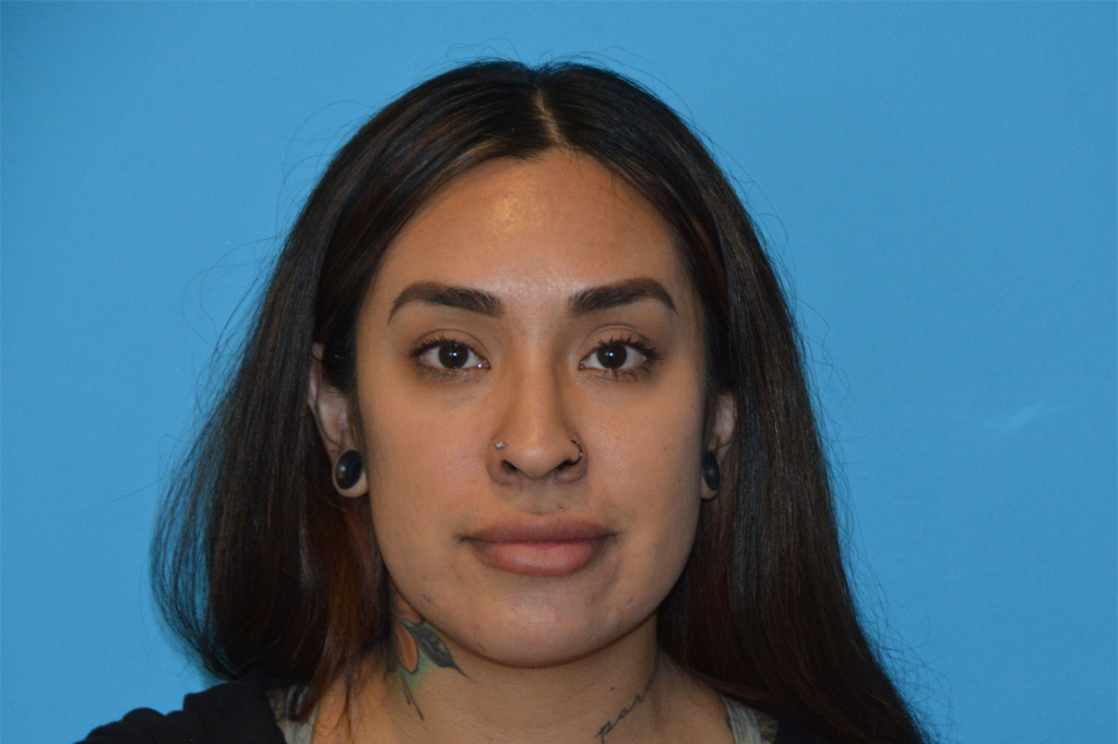 Facial Liposuction Real Patient Results by Dr. Scott Urban in Salt Lake City, Utah