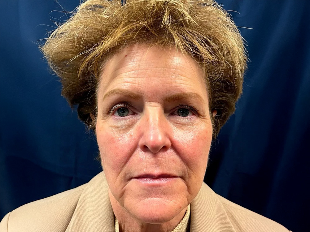 Cheek Implants Real Patient Results by Dr. Scott Urban in Salt Lake City, Utah