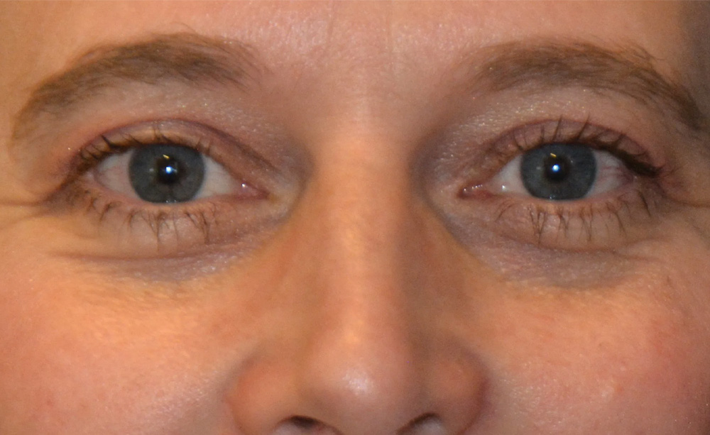Eyelid Surgery Real Patient Results by Dr. Scott Urban in Salt Lake City, Utah
