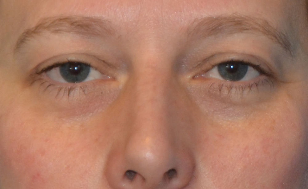Eyelid Surgery Real Patient Results by Dr. Scott Urban in Salt Lake City, Utah