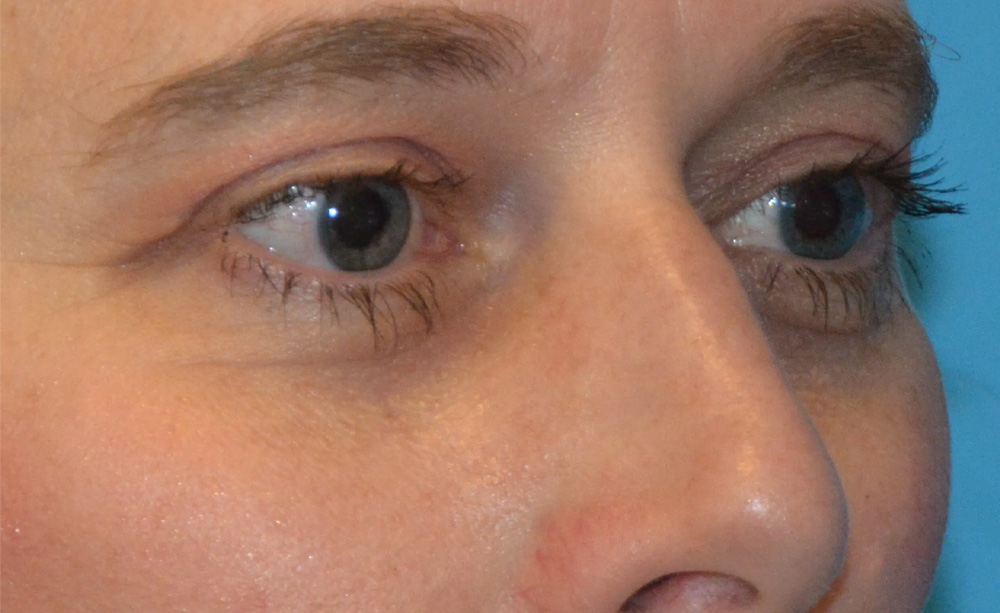 Eyelid Surgery Real Patient Results by Dr. Scott Urban in Salt Lake City, Utah