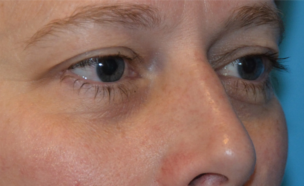Eyelid Surgery Real Patient Results by Dr. Scott Urban in Salt Lake City, Utah