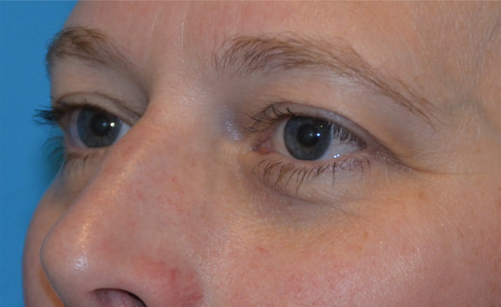 Eyelid Surgery Real Patient Results by Dr. Scott Urban in Salt Lake City, Utah