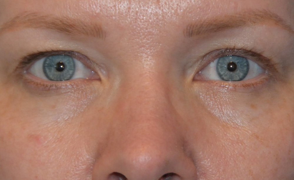 Eyelid Surgery Real Patient Results by Dr. Scott Urban in Salt Lake City, Utah