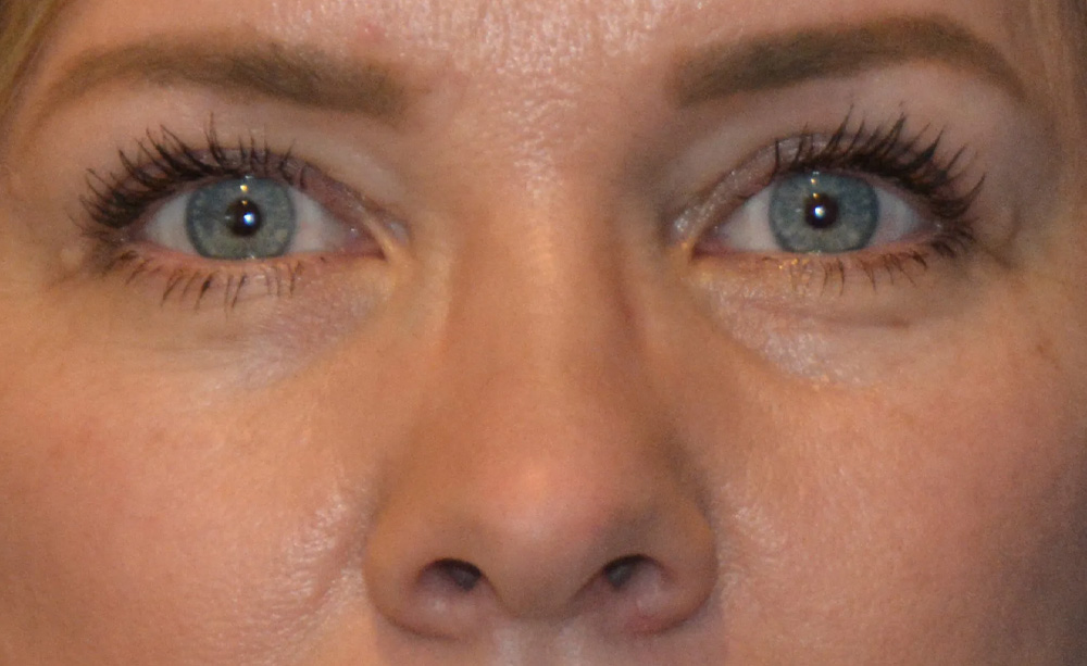 Eyelid Surgery Real Patient Results by Dr. Scott Urban in Salt Lake City, Utah