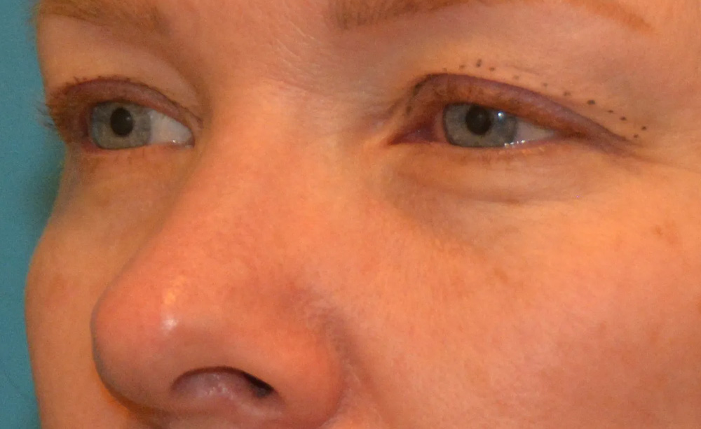 Eyelid Surgery Real Patient Results by Dr. Scott Urban in Salt Lake City, Utah