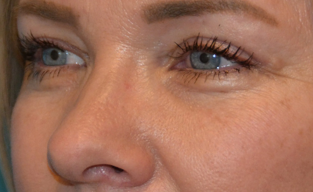 Eyelid Surgery Real Patient Results by Dr. Scott Urban in Salt Lake City, Utah