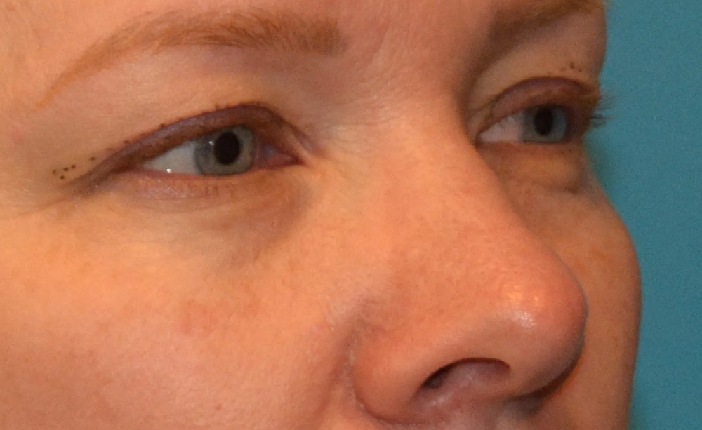 Eyelid Surgery Real Patient Results by Dr. Scott Urban in Salt Lake City, Utah