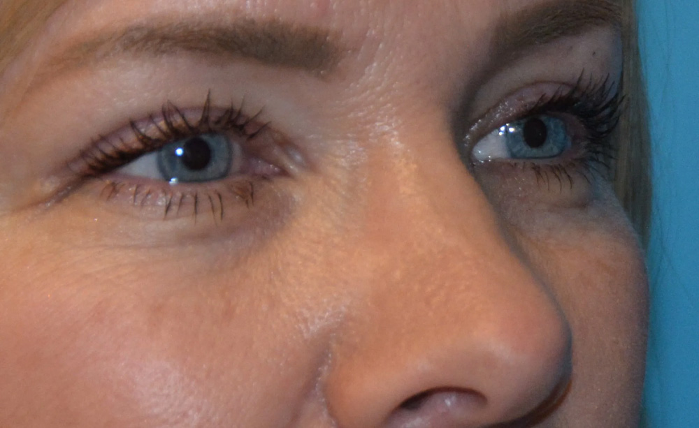 Eyelid Surgery Real Patient Results by Dr. Scott Urban in Salt Lake City, Utah