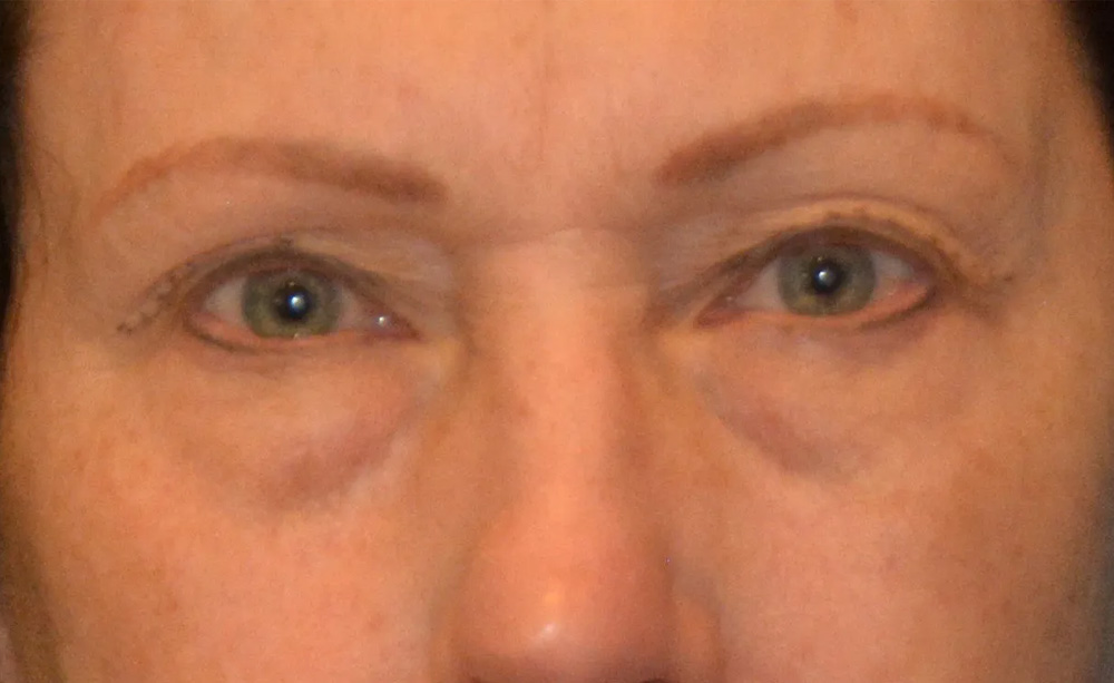 Eyelid Surgery Real Patient Results by Dr. Scott Urban in Salt Lake City, Utah