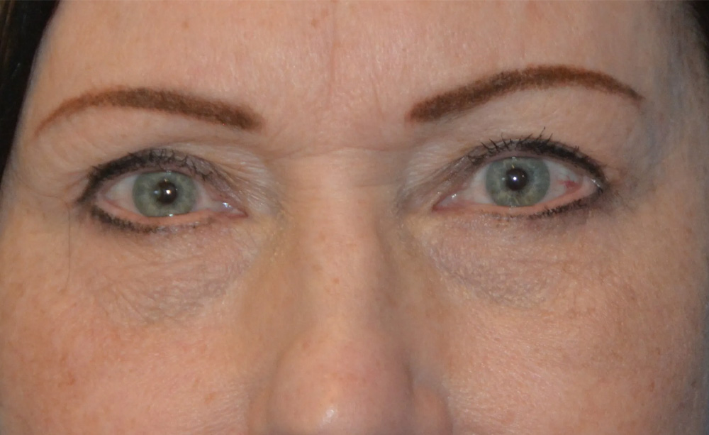 Eyelid Surgery Real Patient Results by Dr. Scott Urban in Salt Lake City, Utah