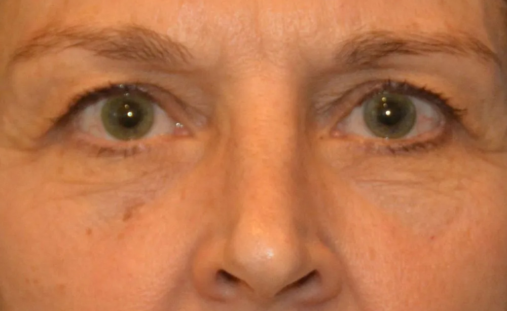 Eyelid Surgery Real Patient Results by Dr. Scott Urban in Salt Lake City, Utah