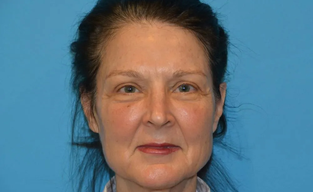 Eyelid Surgery Real Patient Results by Dr. Scott Urban in Salt Lake City, Utah