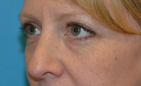Eyelid Surgery Real Patient Results by Dr. Scott Urban in Salt Lake City, Utah