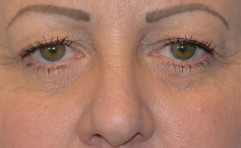 Eyelid Surgery Real Patient Results by Dr. Scott Urban in Salt Lake City, Utah