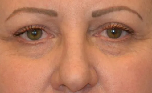 Eyelid Surgery Real Patient Results by Dr. Scott Urban in Salt Lake City, Utah