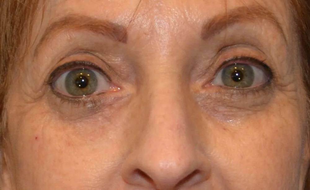 Eyelid Surgery Real Patient Results by Dr. Scott Urban in Salt Lake City, Utah