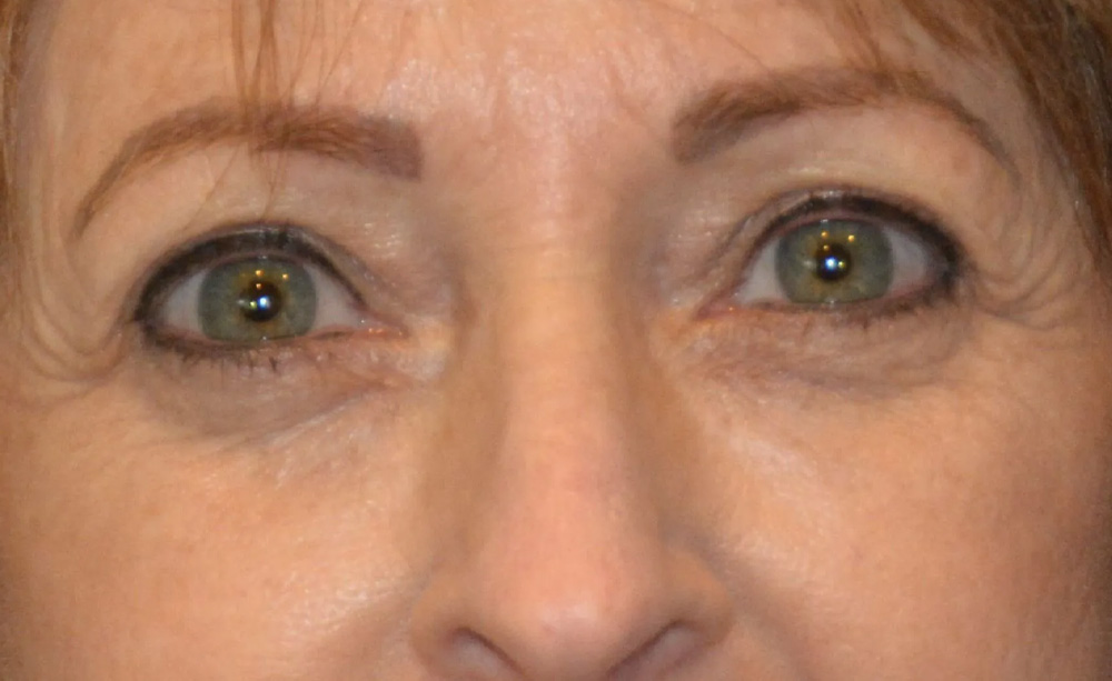 Eyelid Surgery Real Patient Results by Dr. Scott Urban in Salt Lake City, Utah