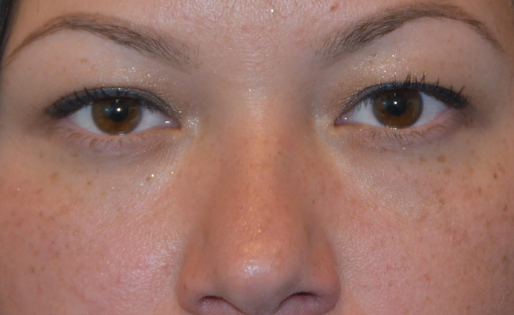 Eyelid Surgery Real Patient Results by Dr. Scott Urban in Salt Lake City, Utah