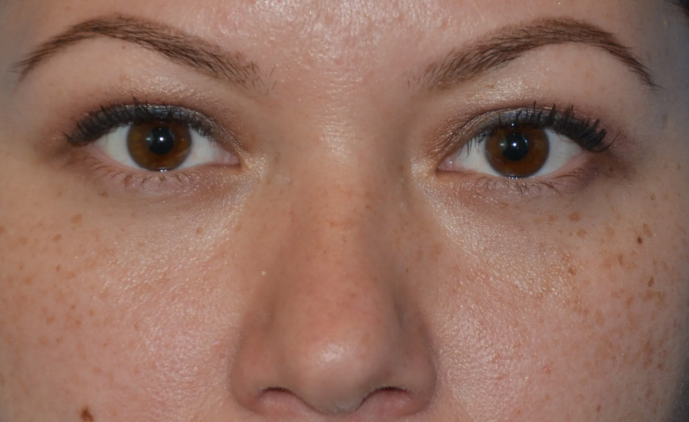 Eyelid Surgery Real Patient Results by Dr. Scott Urban in Salt Lake City, Utah