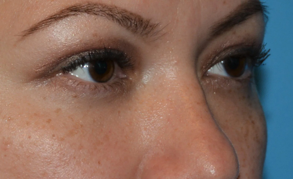 Eyelid Surgery Real Patient Results by Dr. Scott Urban in Salt Lake City, Utah