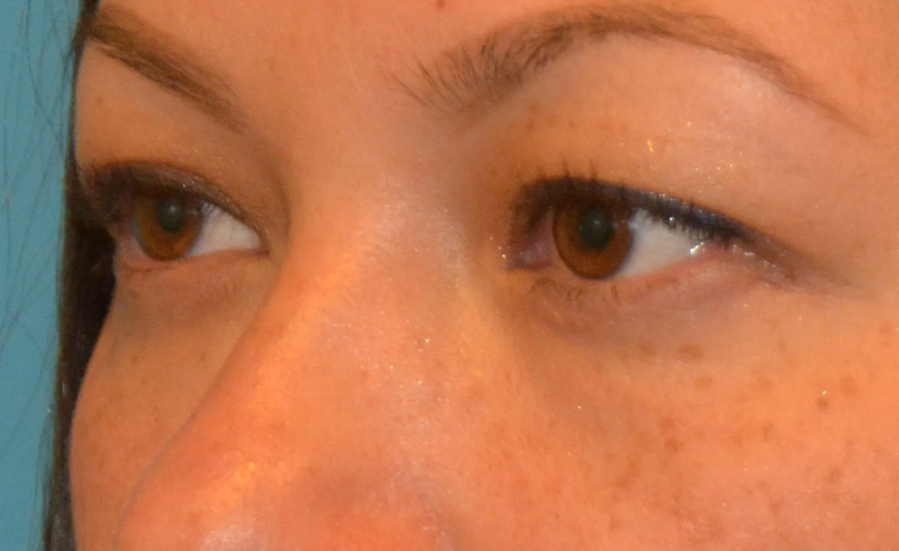Eyelid Surgery Real Patient Results by Dr. Scott Urban in Salt Lake City, Utah