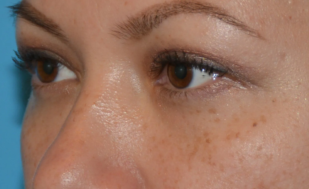 Eyelid Surgery Real Patient Results by Dr. Scott Urban in Salt Lake City, Utah