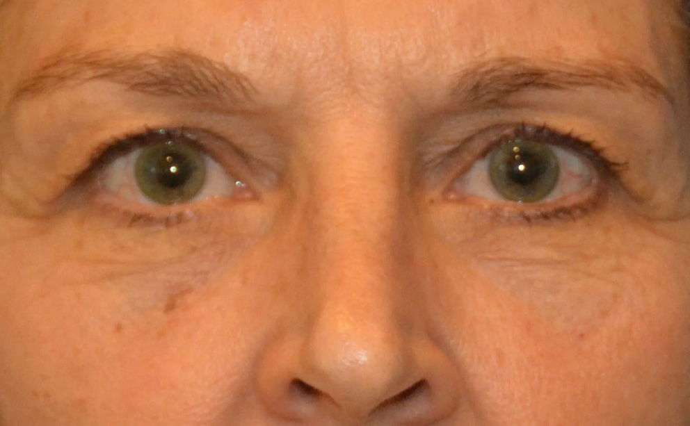 Eyelid Surgery Real Patient Results by Dr. Scott Urban in Salt Lake City, Utah