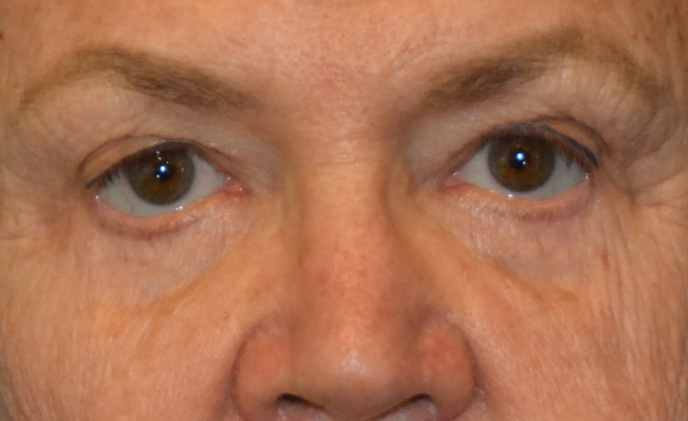 Eyelid Surgery Real Patient Results by Dr. Scott Urban in Salt Lake City, Utah