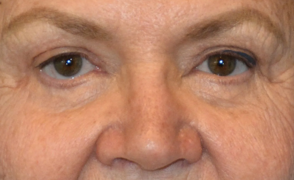 Eyelid Surgery Real Patient Results by Dr. Scott Urban in Salt Lake City, Utah