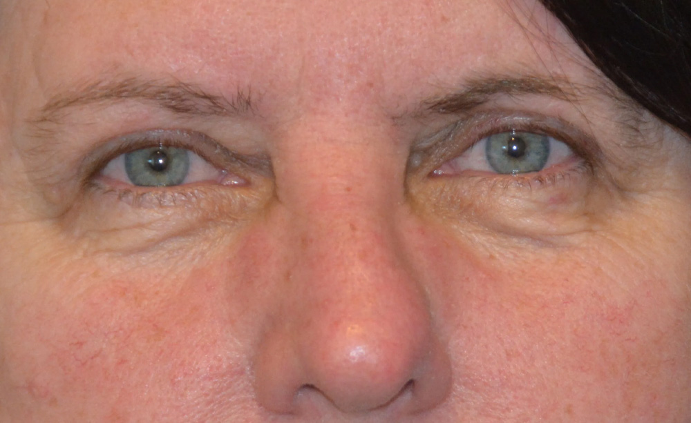 Eyelid Surgery Real Patient Results by Dr. Scott Urban in Salt Lake City, Utah