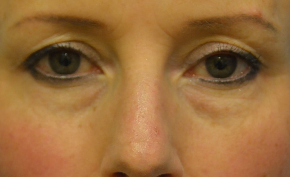Eyelid Surgery Real Patient Results by Dr. Scott Urban in Salt Lake City, Utah
