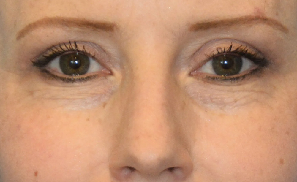 Eyelid Surgery Real Patient Results by Dr. Scott Urban in Salt Lake City, Utah