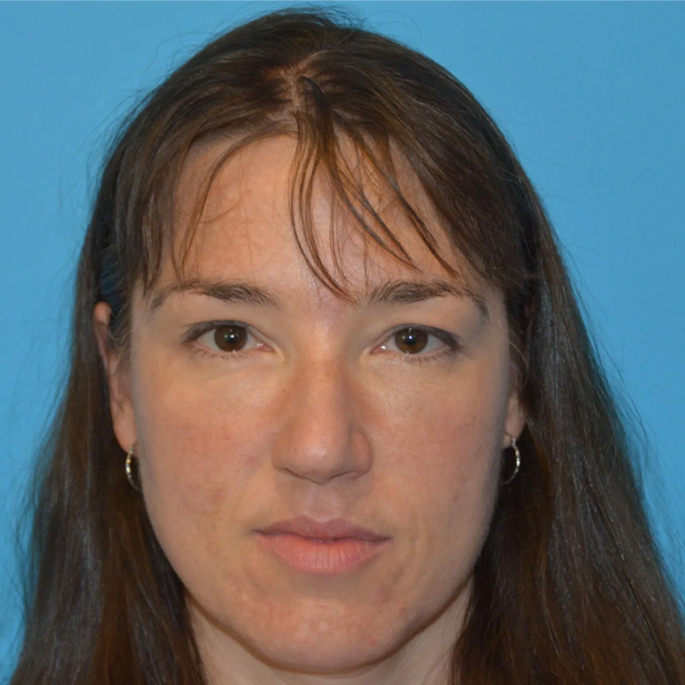 Eyelid Surgery Real Patient Results by Dr. Scott Urban in Salt Lake City, Utah