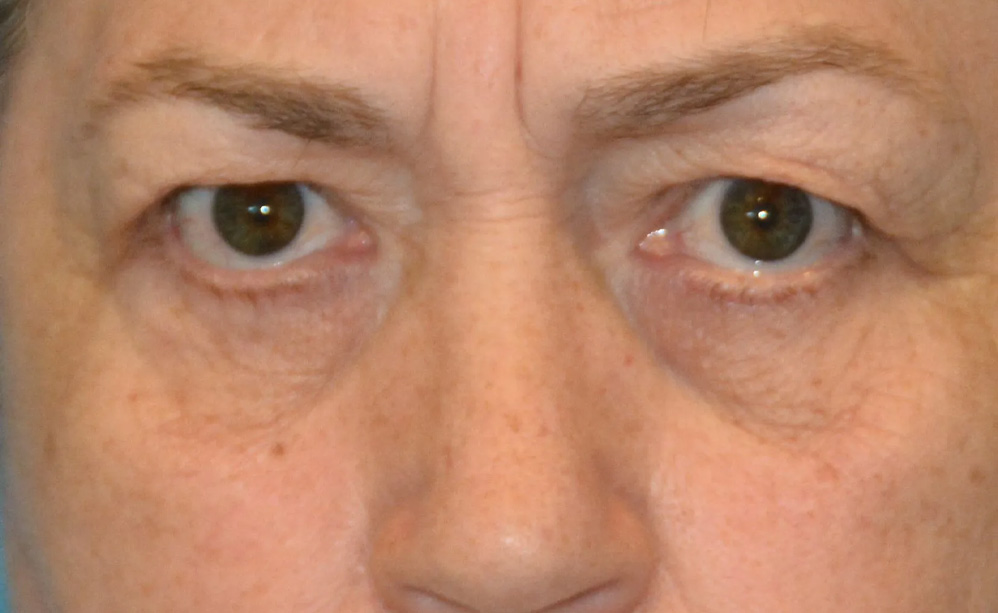 Eyelid Surgery Real Patient Results by Dr. Scott Urban in Salt Lake City, Utah