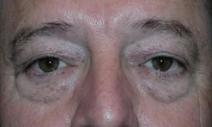 Eyelid Surgery Real Patient Results by Dr. Scott Urban in Salt Lake City, Utah