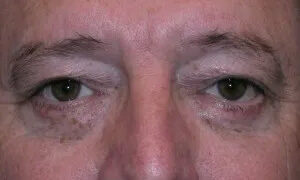 Eyelid Surgery Real Patient Results by Dr. Scott Urban in Salt Lake City, Utah