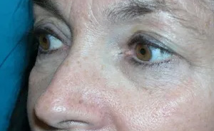 Eyelid Surgery Real Patient Results by Dr. Scott Urban in Salt Lake City, Utah