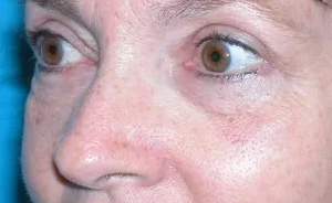 Eyelid Surgery Real Patient Results by Dr. Scott Urban in Salt Lake City, Utah