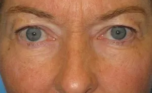 Eyelid Surgery Real Patient Results by Dr. Scott Urban in Salt Lake City, Utah